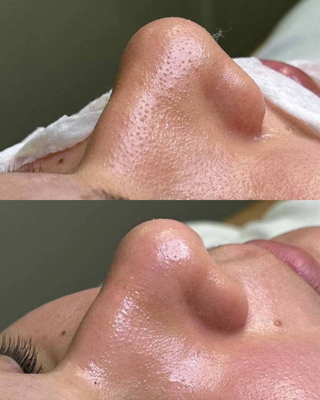 Resultado Limpeza de Pele